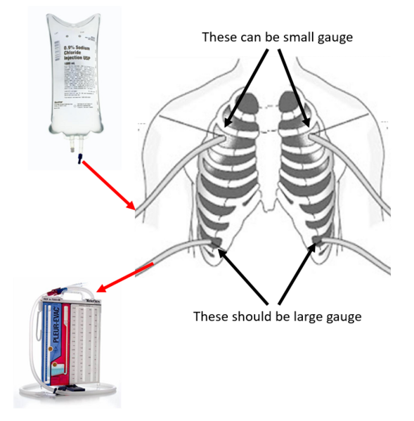 File:Thoracic Lavage Diagram.PNG