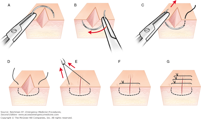 File:Simple interrupted sutures.png