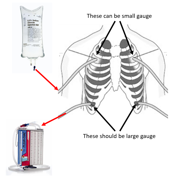 Thoracic Lavage Diagram.PNG