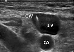 IJV ultrasound.png