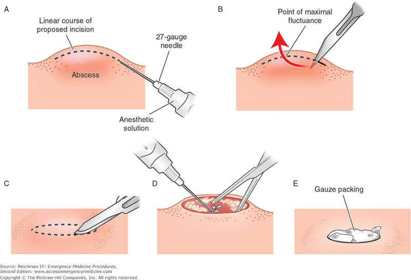 File:Incision and drainage.png