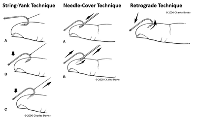 Fishhook Removal - Guide to YKHC Medical Practices